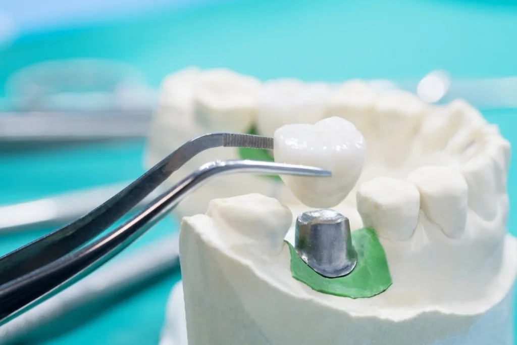 Dental Crown & Bridge Treatment 1 Pune Dental Studio Baner