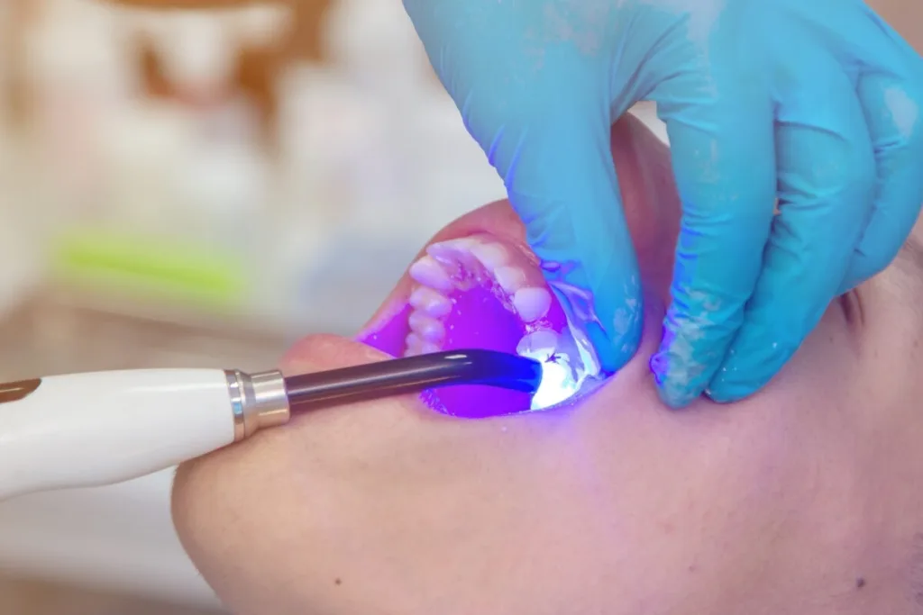 Dental Fillings 1 Pune Dental Studio Baner