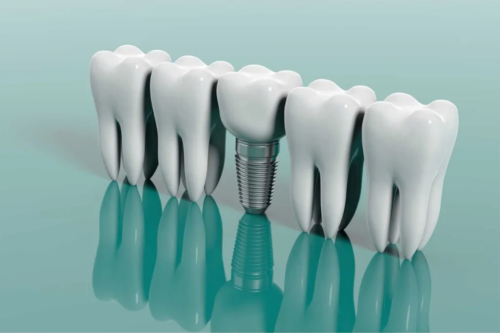 Dental Implants 1 Pune Dental Studio Baner