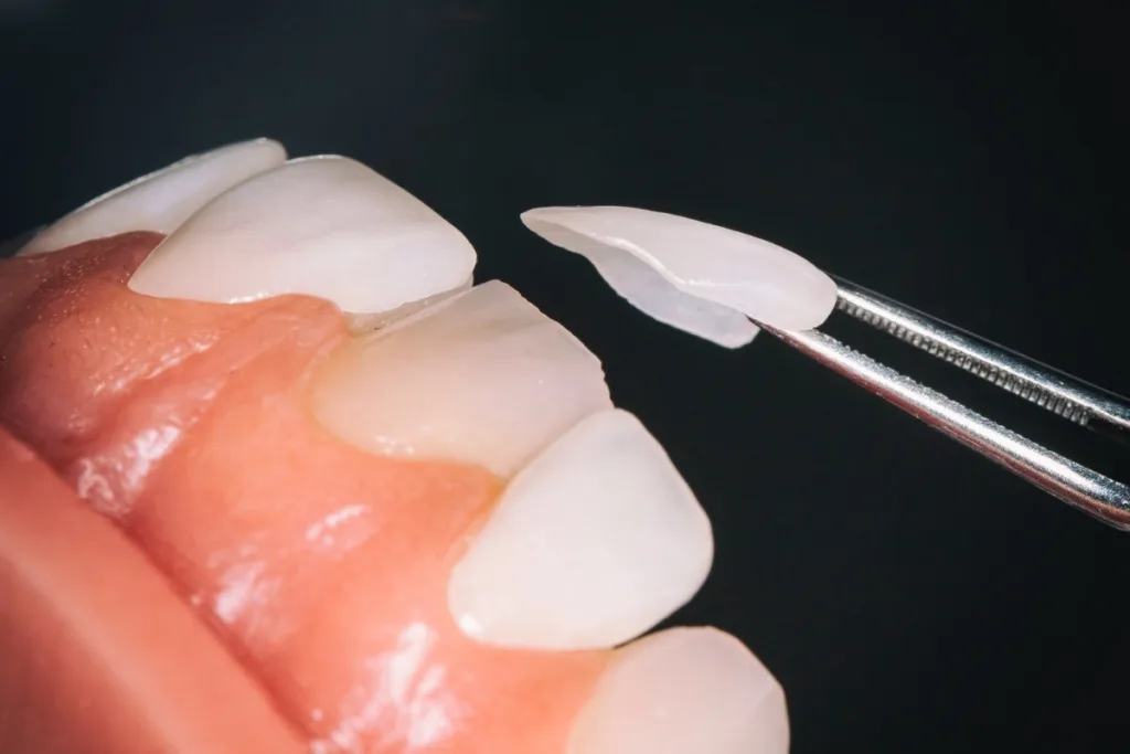 Dental Veeners & Laminates 1 Pune Dental Studio Baner