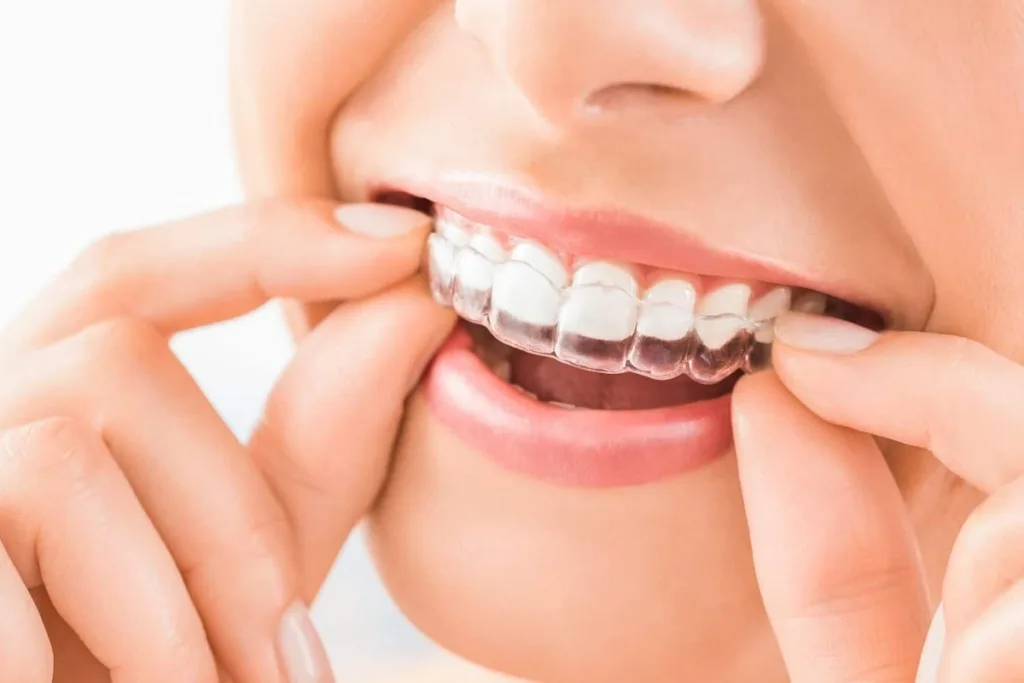 Invisible Braces 1 Pune Dental Studio Baner
