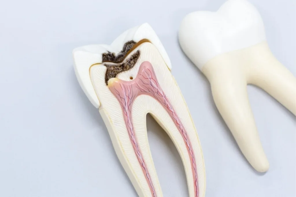 Root Canal Treatment 1 Pune Dental Studio Baner