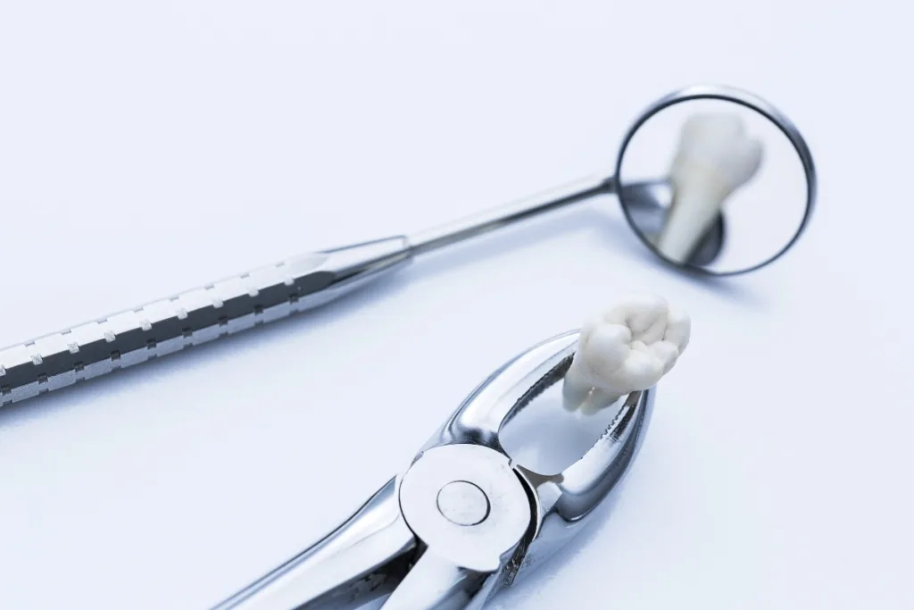 Wisdom Tooth Removal 1 Pune Dental Studio Baner