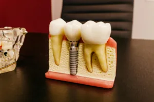 Dental Implants In Pune: A Complete Guide for Patients in Pune and Beyond 1 dental implant structu